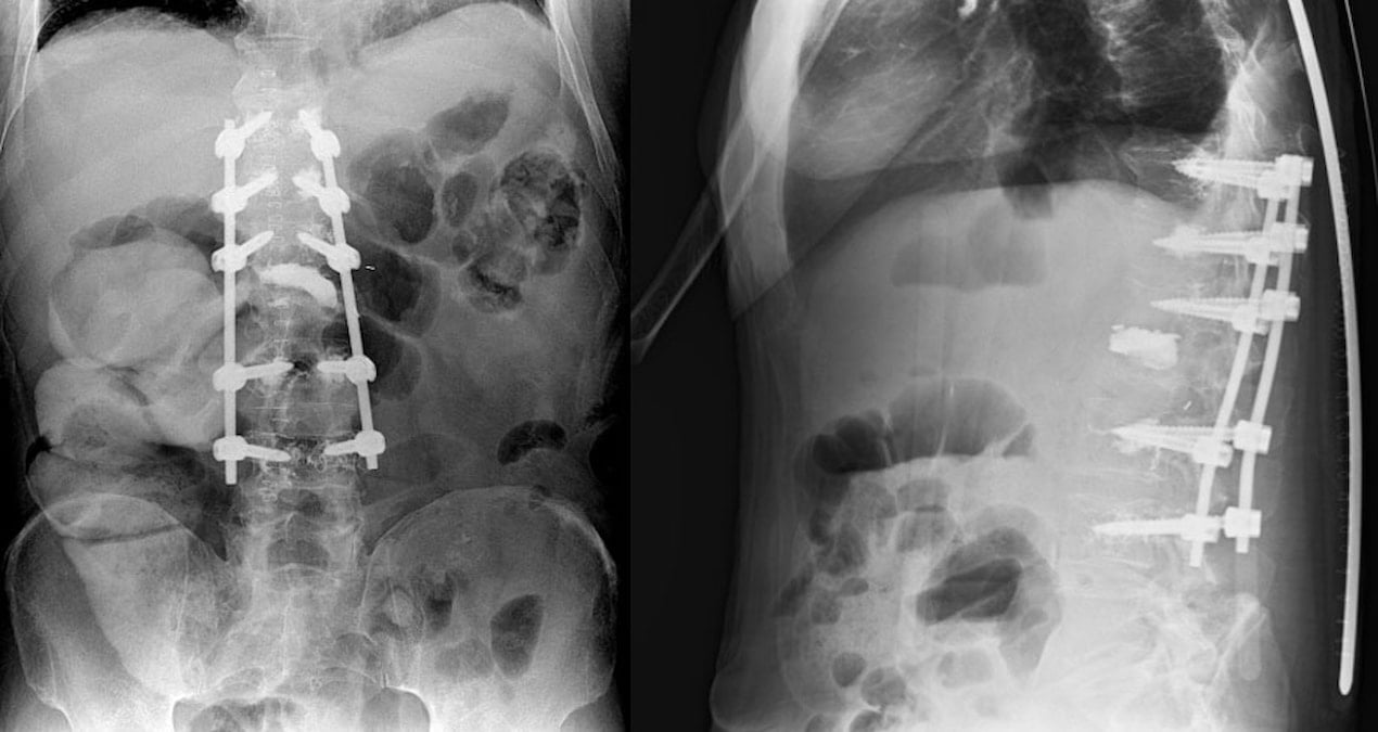 Ağrı Şikayetiyle Hastaneye Başvurdu, 8.5 Kilogramlık Tümörlü Böbrek Teşhis Edildi